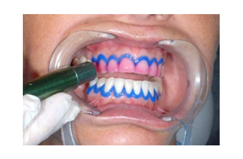 Sbiancamento dentale